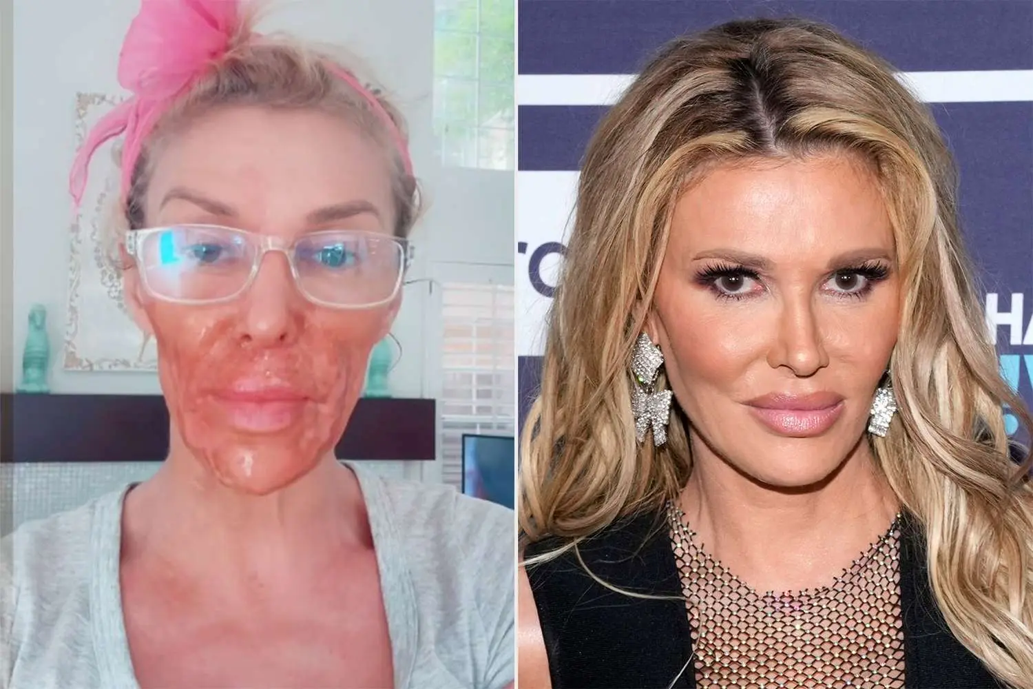 Brandi Glanville sufre quemaduras faciales mientras lucha contra un parásito: ¡Lo que hizo es impactante!- Últimas noticias Ecuador